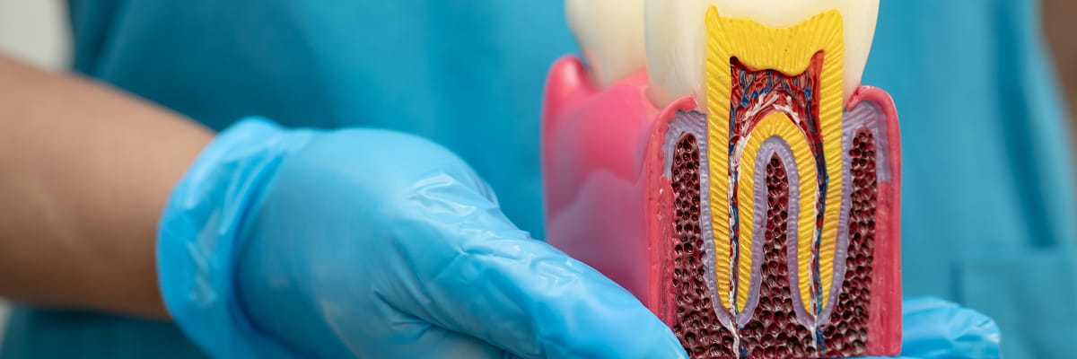 Broken Root Extraction Techniques and Decision Making_Root