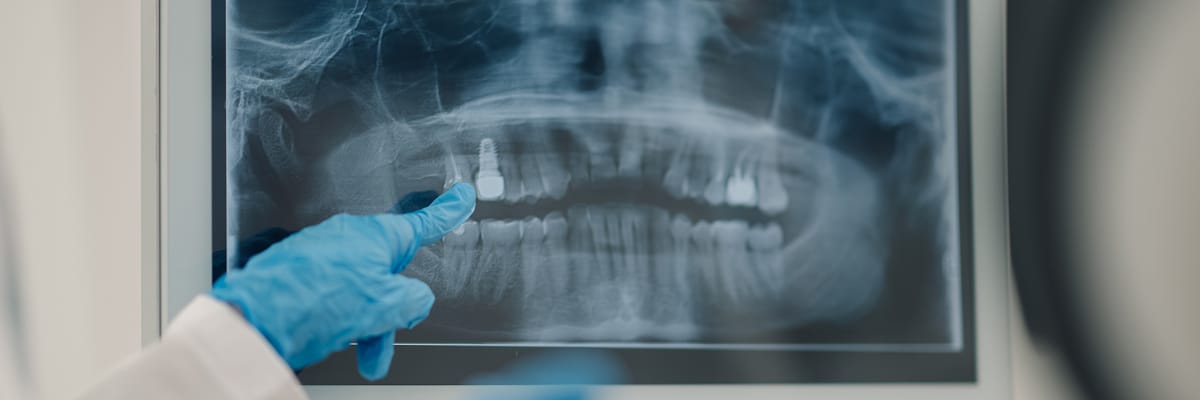 Broken Root Extraction Techniques and Decision Making_XRay